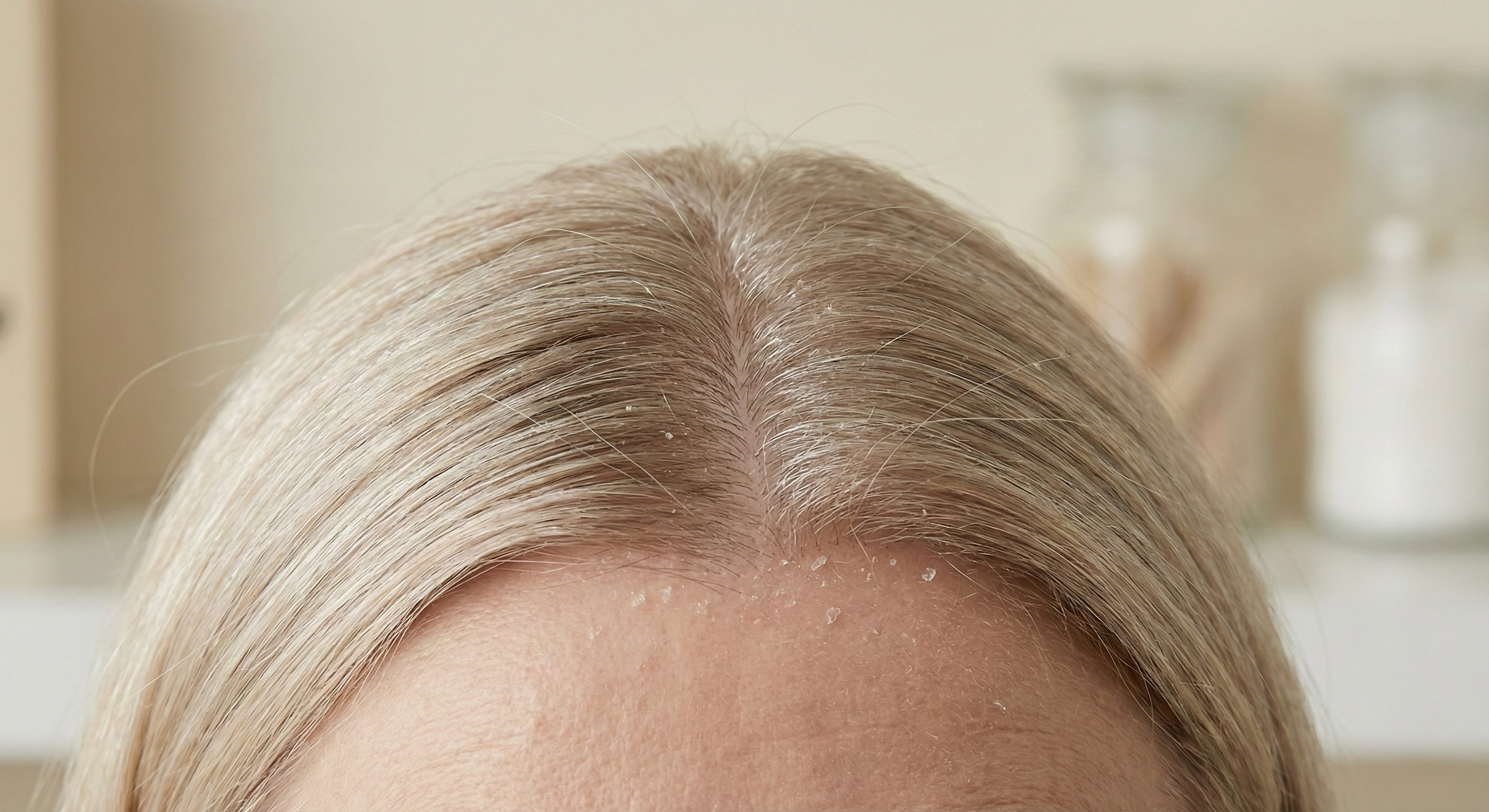 Close up of a hair part showing mild scalp dryness and flakes linked to scalp tenderness and thinning